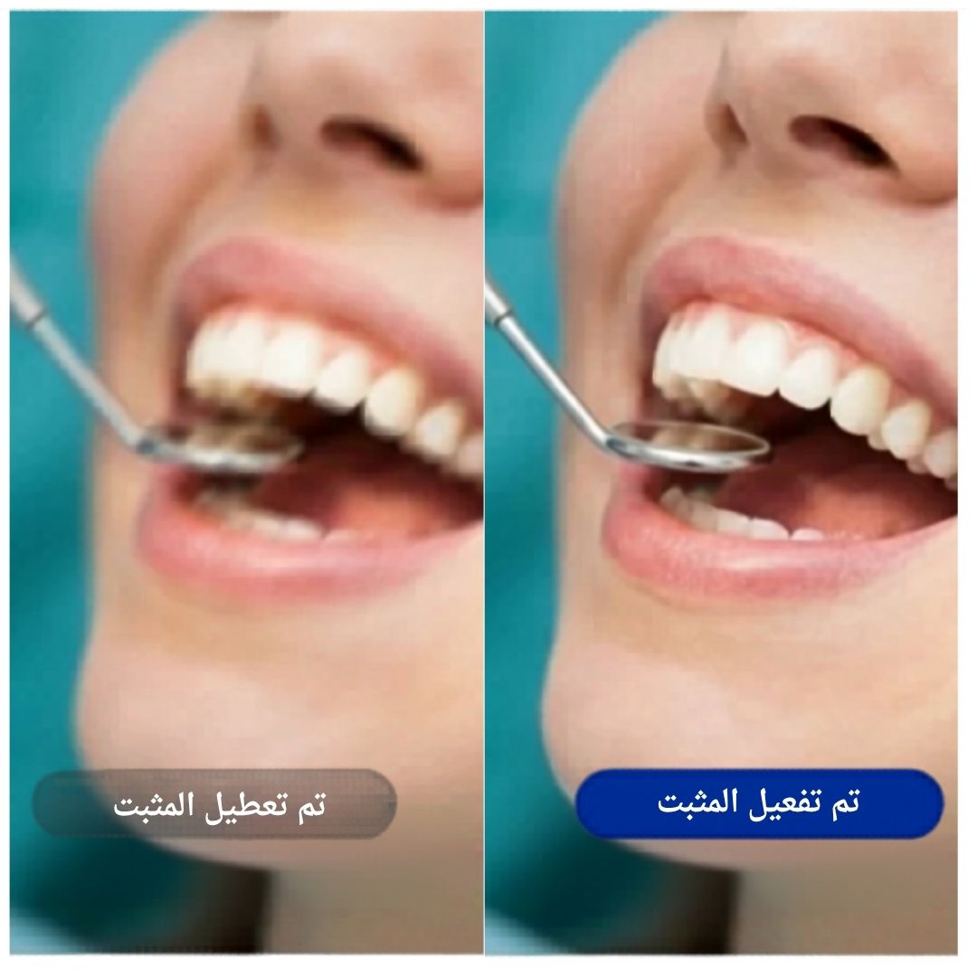 [locale:ar] مقارنة تثبيت الصورة: إيقاف مقابل تشغيل — تسجيل أسنان أكثر وضوحًا
